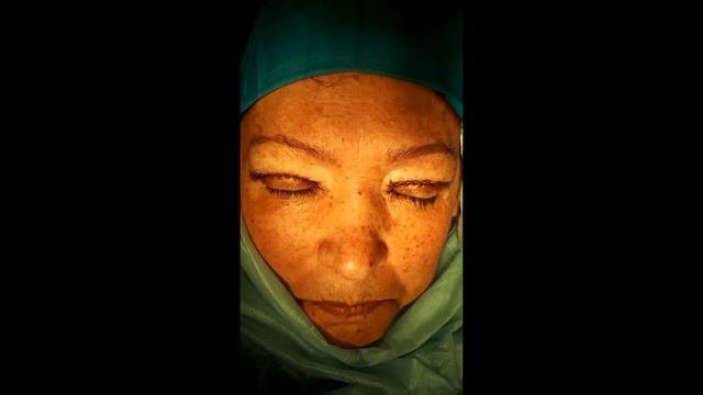 Блефаропластика верхние веки смотреть онлайн