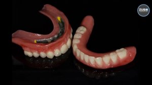 Съёмные протезы  на Ti балке с ответной частью CoCr.