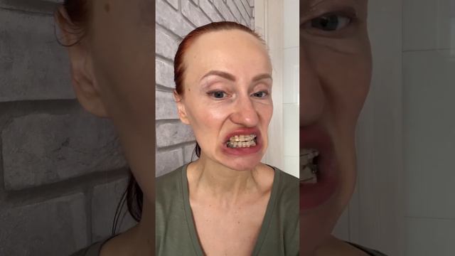 Моя 5 коррекция брекетов. Чего ожидать после. Возвращаемся в детство 👶 смотреть онлайн