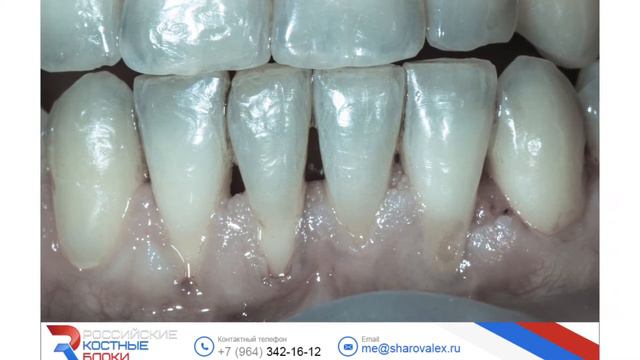 23.04.16. Мария Носова. Практикум по пластике десны. Эпизод 21 смотреть онлайн