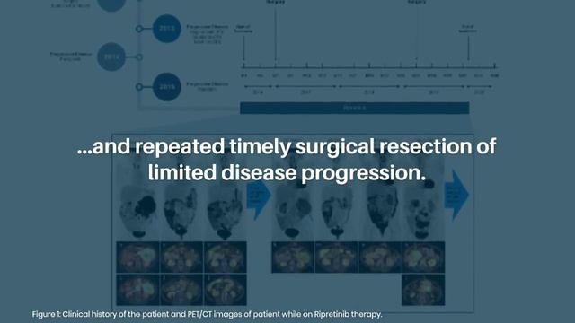 Managing Recurrent GIST with Ripretinib and Surgery | Oncoscience смотреть онлайн