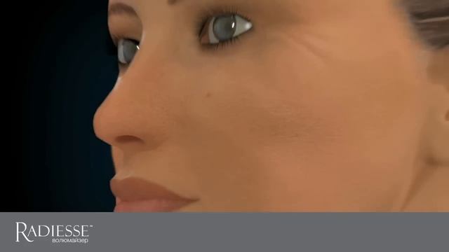 Radiesse™ (Радиес), механизм действия