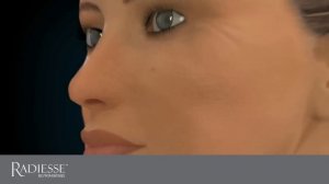 Radiesse™ (Радиес), механизм действия