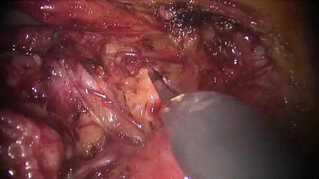 Robot assisted right recurrent lymph node dissection смотреть онлайн