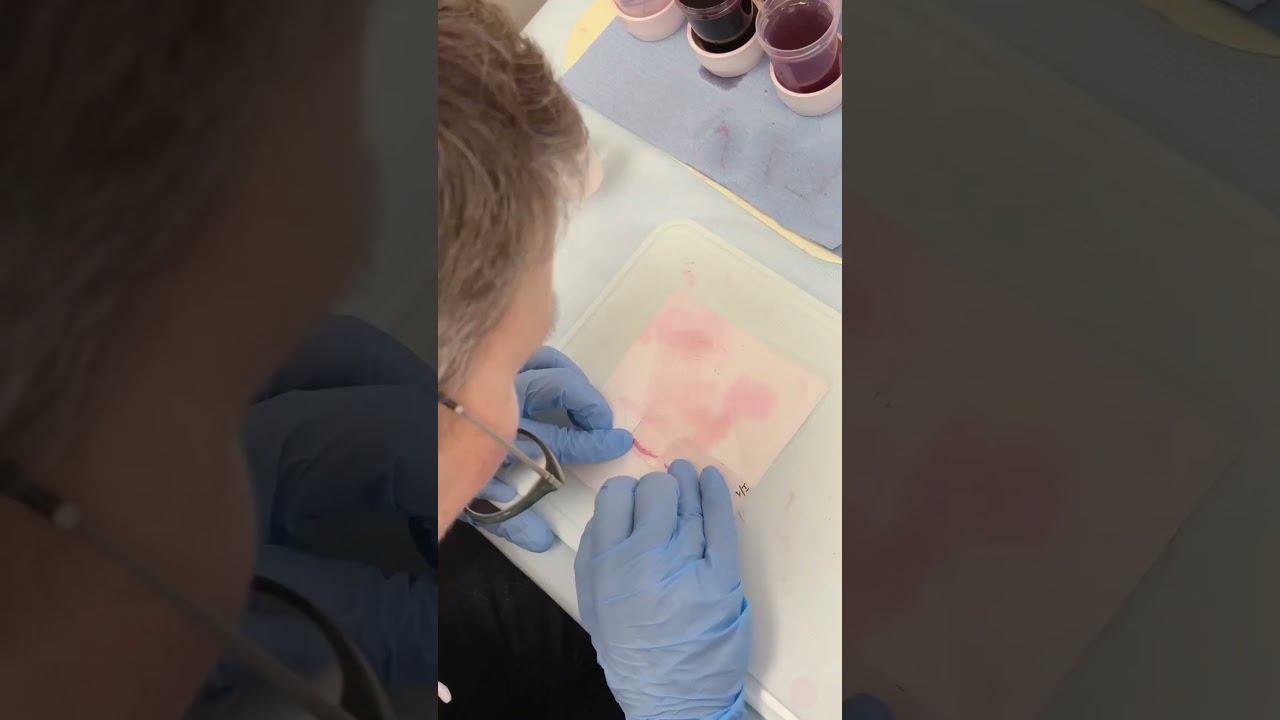 Гистологическое исследование - один из ключевых этапов микрографической хирургии (Mohs). смотреть онлайн