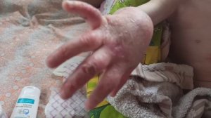 Последний месяц лета и состояние кожи ребенка с синдромом бабочки.