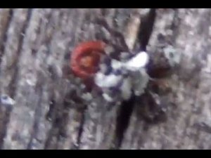 ПУЗЫРЬ на ПОПКЕ - Энцефалитный КЛЕЩ ПИХТОВАЯ СМОЛА ОЖОГИ КЛЕЩА