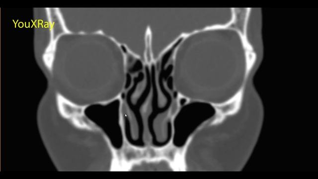 Лучевая анатомия остиомеатального комплекса и полости носа смотреть онлайн