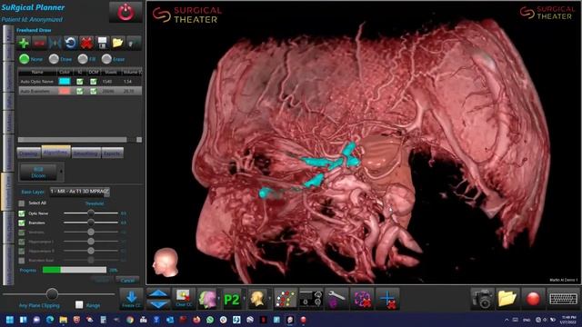 AI Auto Segmentation Cranial 1 смотреть онлайн