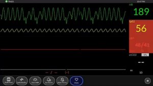 остановка сердца