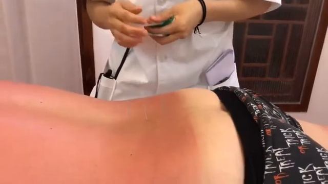 Китайская медицина. Иглоукалывание. Хоросо! #хайнань #китай смотреть онлайн