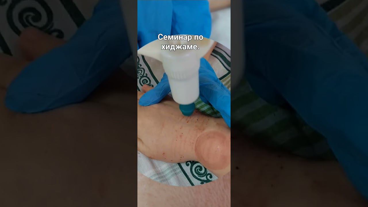 Хиджама. Лечебно-омолаживающая процедура. смотреть онлайн