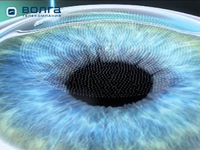 Бесконтактная коррекция зрения. Фемтолазер VisuMax смотреть онлайн