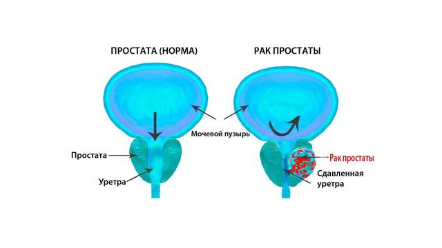 О хроническом простатите с Петруняевым Анатолием Ивановичем, урологом, врачом высшей категории. смотреть онлайн
