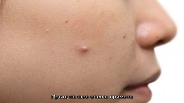 К чему выскочил прыщ на шее: приметы и суеверия смотреть онлайн