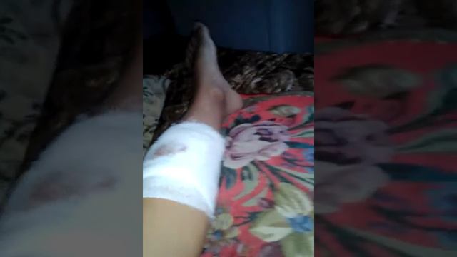 Я проткнул ногу железкой от кочели смотреть онлайн