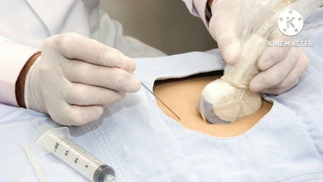 Amniosintesis | Amniosintesis Malayalam | Down Syndrom Test смотреть онлайн