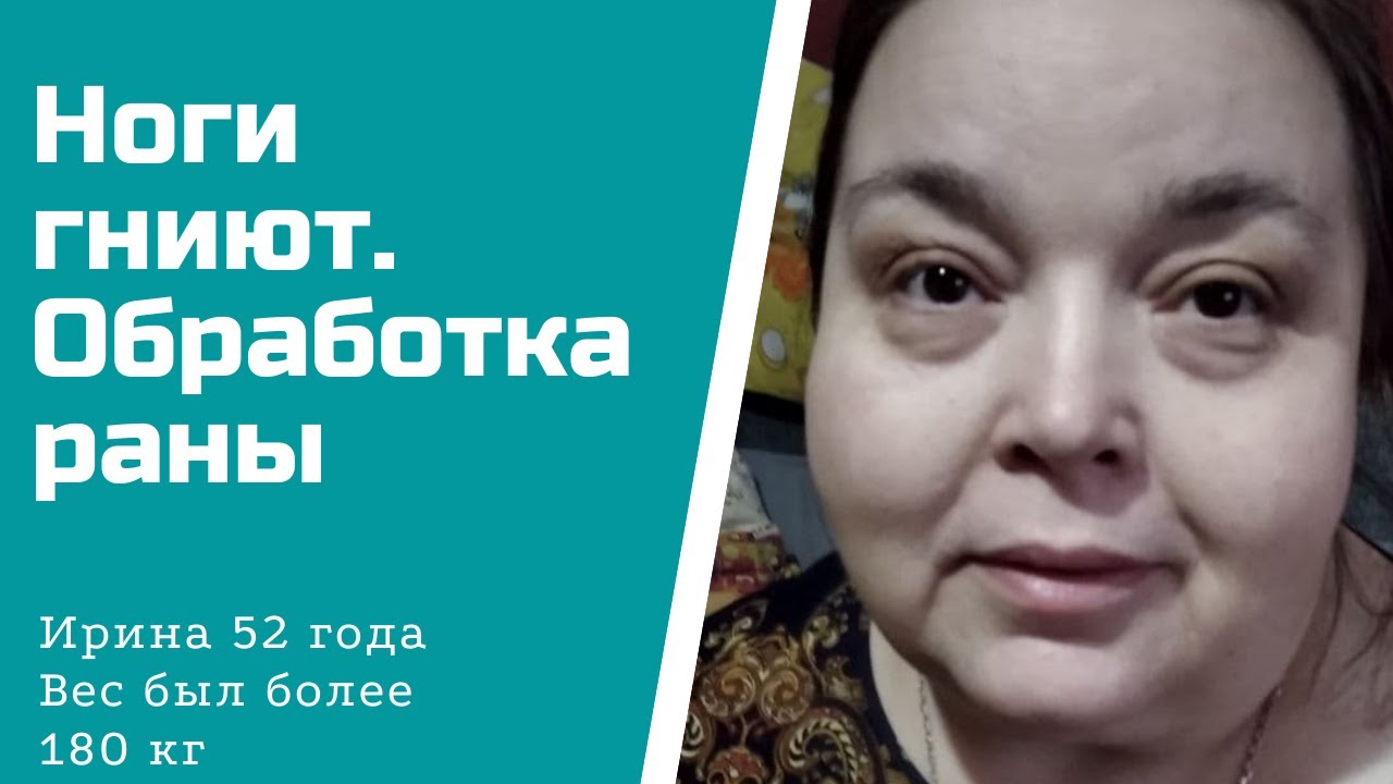 Вес 180 кг. Трофические язвы. АСД 3..mp4 смотреть онлайн