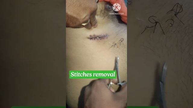 stitches removal procedure #shorts #medical смотреть онлайн