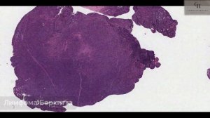 Лимфомы (лимфома Ходжкина, неходжкинские лимфомы) | Патологическая анатомия