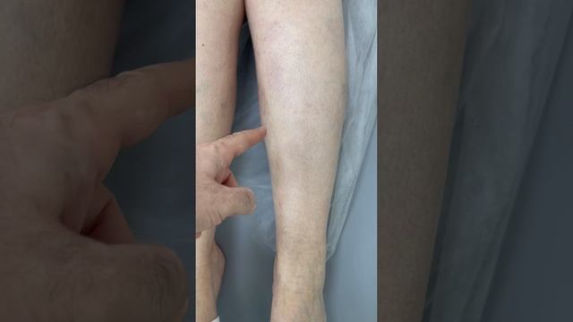 Нога после операции. Лечение варикоза. Флеболог Москва. Флеболог смотреть онлайн