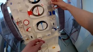 How to setup dialysis fresenius 5008 machine French/dialyse