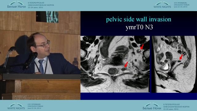 Технические аспекты хирургического лечения распространенных опухолей тазовых органов смотреть онлайн