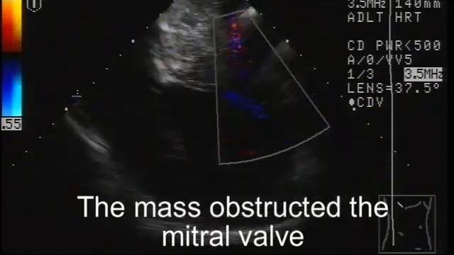 21. Миксома левого предсердия (cardiac myxoma) смотреть онлайн