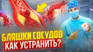 БЛЯШКИ СОСУДОВ. Причины образования атеросклероза и как уменьшить его проявления.