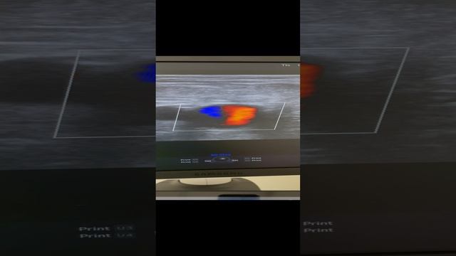 Тромбоз глубоких вен после химиотерапии. Узи вен. Сосудистый хирург. Флеболог. Флеболог Москва смотреть онлайн