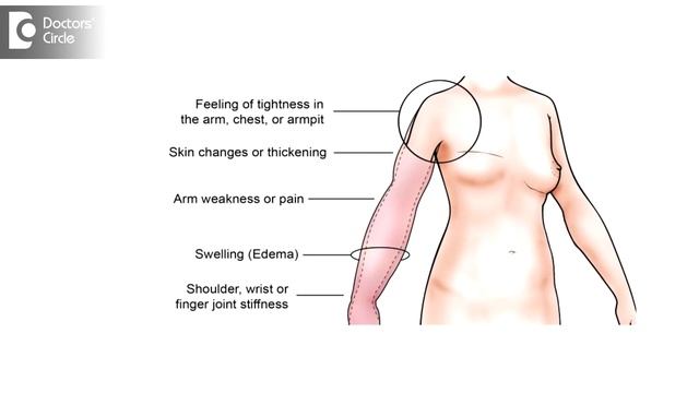 Breast Cancer related Lymphedema : Causes, Symptoms & Treatment-Dr.Nanda Rajaneesh| Doctors' Circle смотреть онлайн