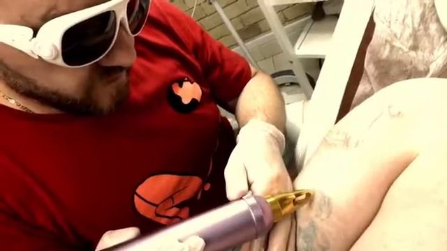 Удаление татуировки, мастер Александр Зарицкий #notattoo #aleksandrzaritskyi #удалениетату смотреть онлайн