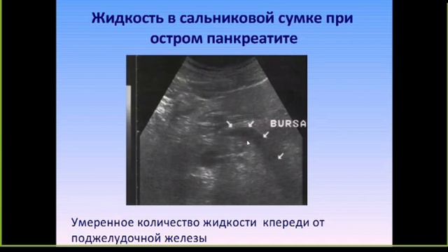 УЗИ поджелудочной железы смотреть онлайн