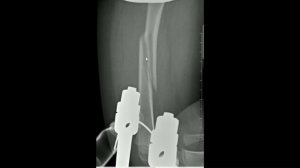 Скелетное вытяжение. Перелом бедра у ребенка лечение.