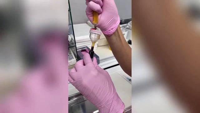 PRP-инъекции на позвоночник, шейный и грудной отдел. смотреть онлайн