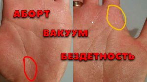 Аборт, вакуум и его последствия. Хиромантия