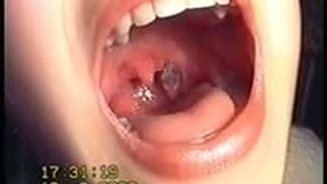 Рак смотреть онлайн