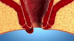 Виды геморроя