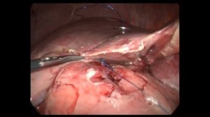 Прободная язва двенадцатиперстной кишки, перитонит Lap repair duodenal ulcer