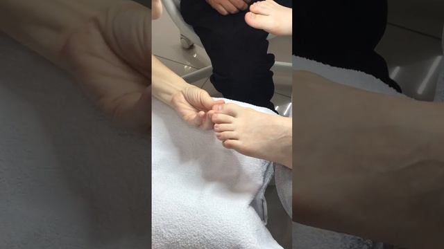 Установка титановой нити - Подология