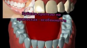 Зубные протезы на присосках - особенности