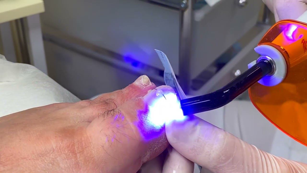 Установка титановой пластины на ноготь смотреть онлайн