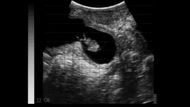 Easi-Scan Curve. Смотрим нормально развитый плод на сроке 50 дней + желтое тело смотреть онлайн