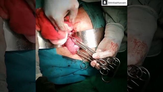 Total Abdominal Hystrectomy | Stepwise Surgery Explained | Surgeon Dr Imtiaz Hussain смотреть онлайн