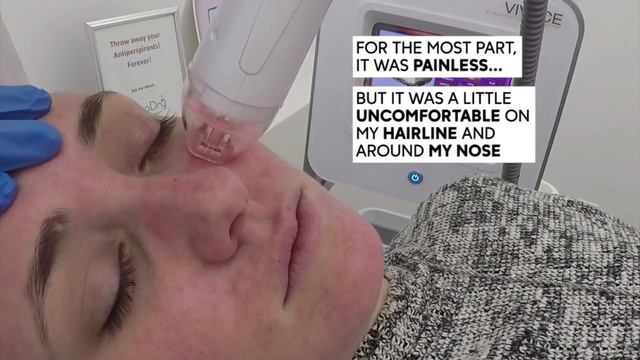 Vivace RF Microneedling | Patient Review смотреть онлайн