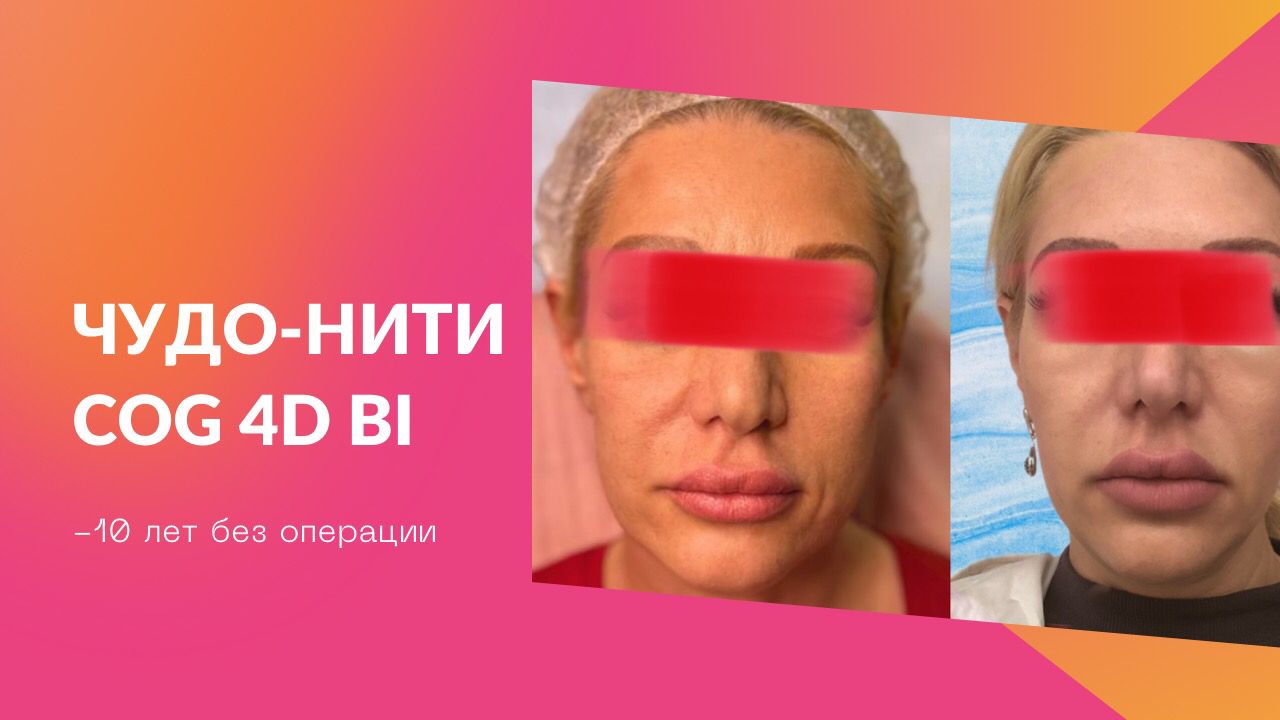 Подтяжка лица нитями Cog. Нити коги.