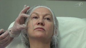 Треугольник по Ландау. Контурная пластика обучение Princess