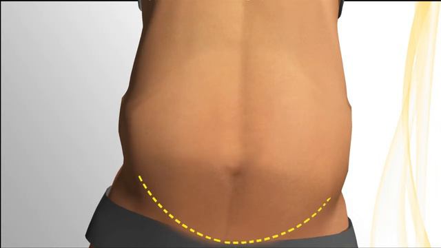 Tummy tuck, Testimonial and tips. Plastic surgery in Mexico. смотреть онлайн