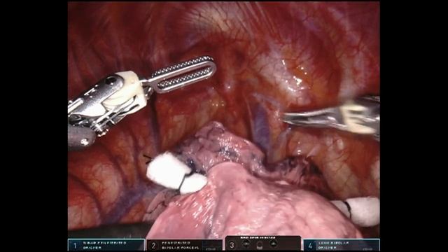 Right thoracic anatomy - narrated смотреть онлайн
