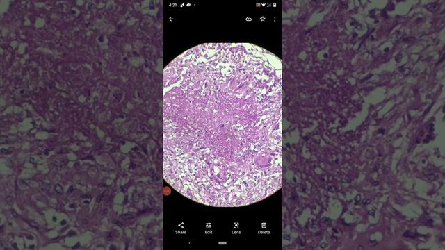 tuberculous lymphadenitis смотреть онлайн